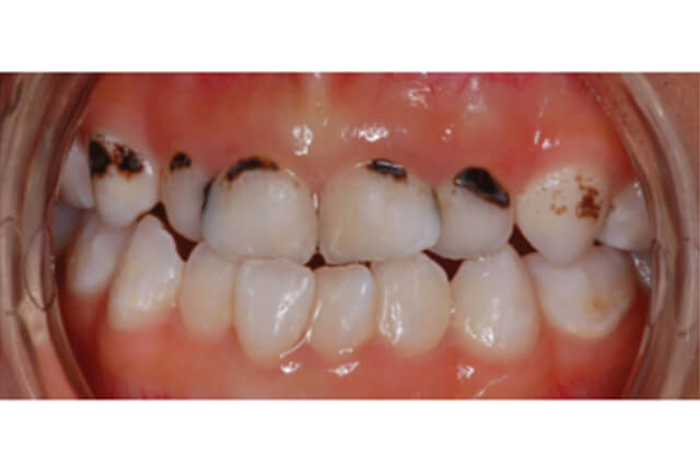 EARLY CHILDHOOD CARIES