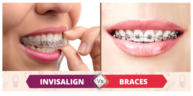 WANT A PERFECT SMILE ; BUT TIRED OF METAL BRACES?