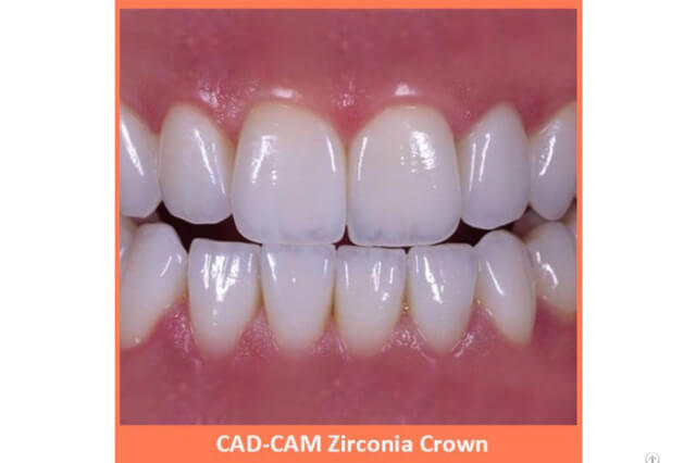 METAL FREE CROWN