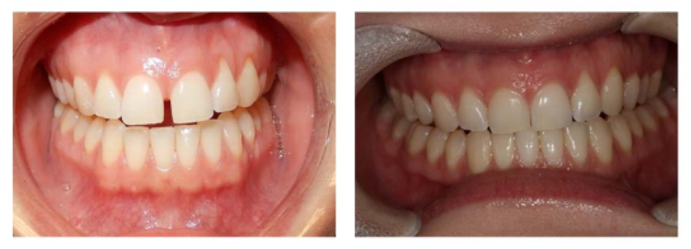 MIDLINE DIASTEMA CLOSURE
