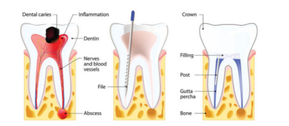 ROOT CANAL TREATMENT